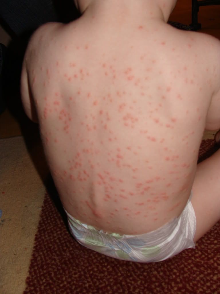 Possible Chicken Pox after immunization-photos - BabyCenter